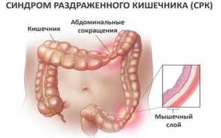 Обложенный язык при синдроме раздраженного кишечника