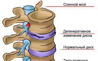 Корешковый синдром грудного отдела гимнастика