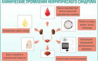 Различия нефротического и нефритического синдромов