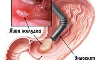 Язвенная болезнь желудка клинические синдромы