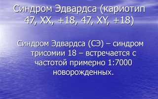 Синдром эдвардса фото и признаки