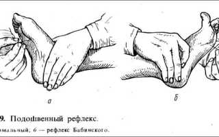 Синдром маринеску радовича у взрослых