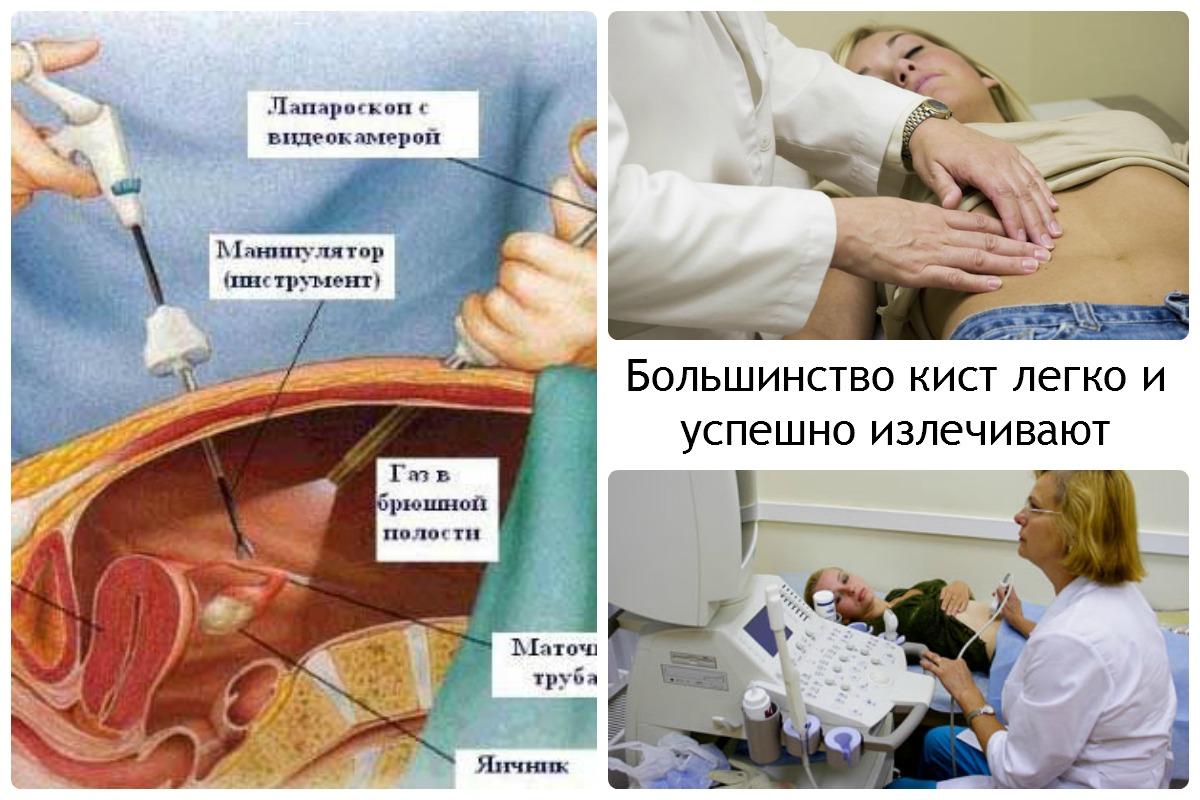 Разрыв кисты яичника