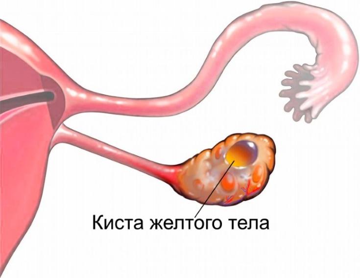 Разрыв кисты яичника