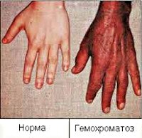 Гемохроматоз