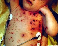 Геморрагическая болезнь новорожденных