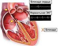 Атриовентрикулярная блокада