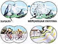 Мигрень с аурой