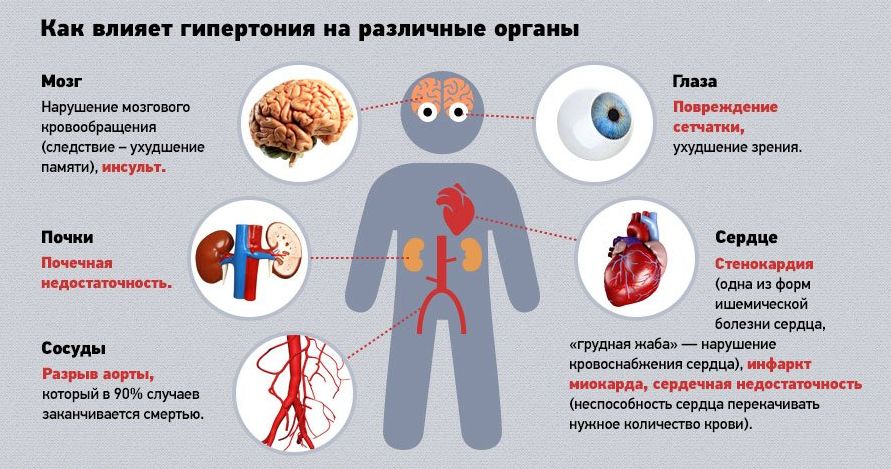 Синдром позвоночной артерий по мкб