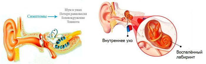 Синдром вегетативной дисфункции с вестибулопатией