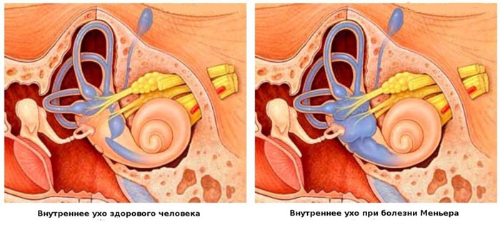 Синдром вегетативной дисфункции с вестибулопатией