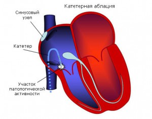 Синдром укороченного pq что это такое у взрослых