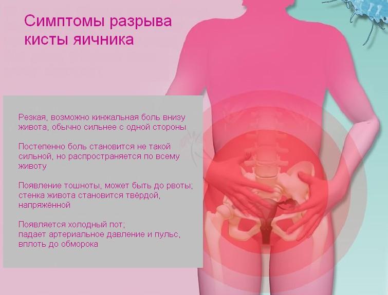 Разрыв кисты яичника