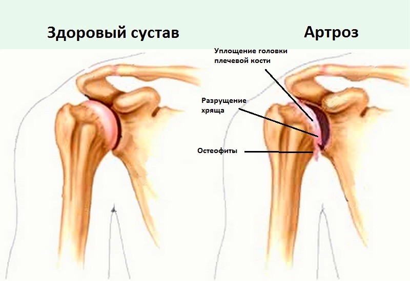 Блокада болевого синдрома плечевого сустава