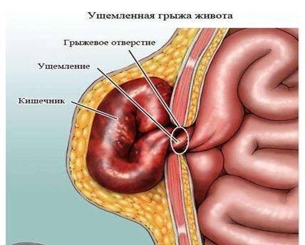 Грыжа околопупочная код мкб