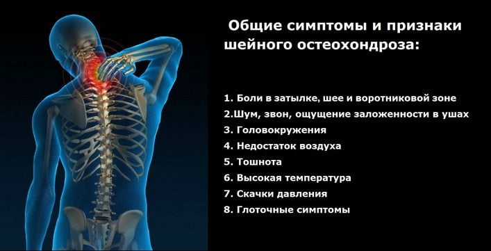 Остеохондроз пояснично крестцового отдела с радикулярным синдромом