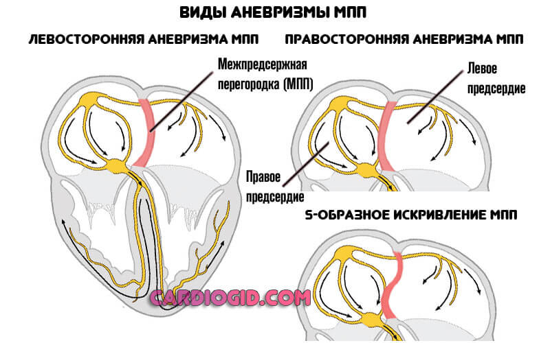 аневризма-мпп