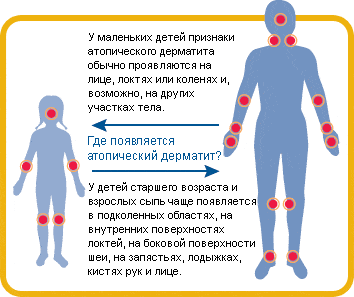 Типичная локализация сыпи при атопическом дерматите