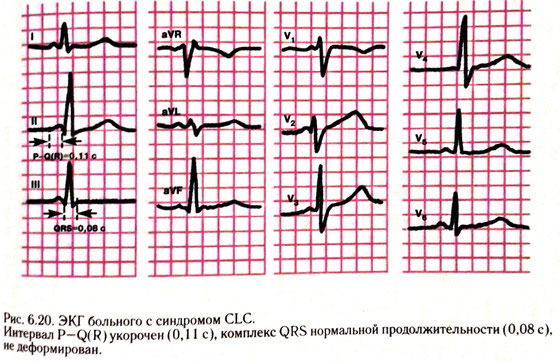 Синдром clc на экг что это такое