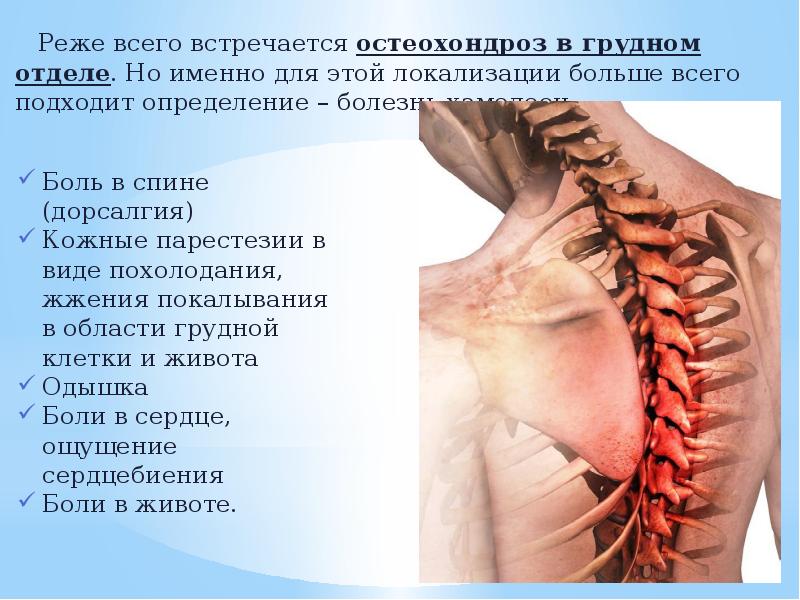 Остеохондроз пояснично крестцового отдела с радикулярным синдромом