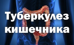 Туберкулез кишечника