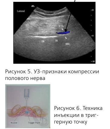 Лечение миофасциального синдрома в сочи