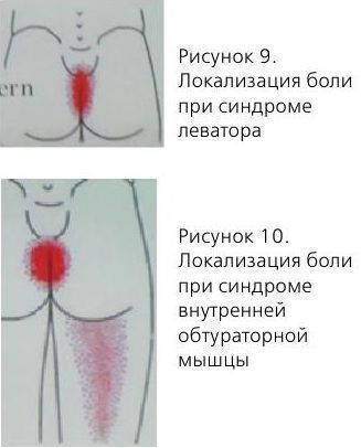 Лечение миофасциального синдрома в сочи