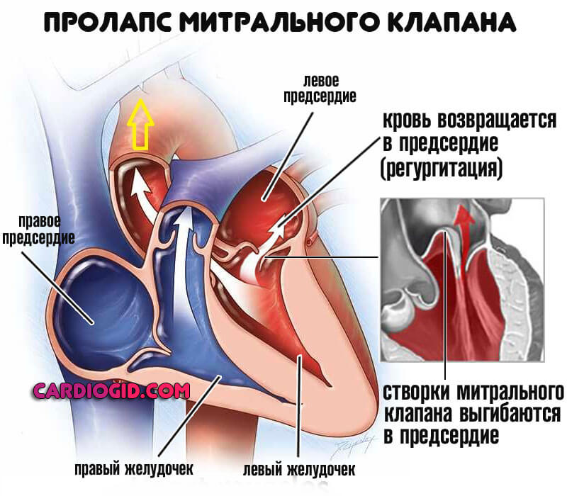пролапс митрального клапана