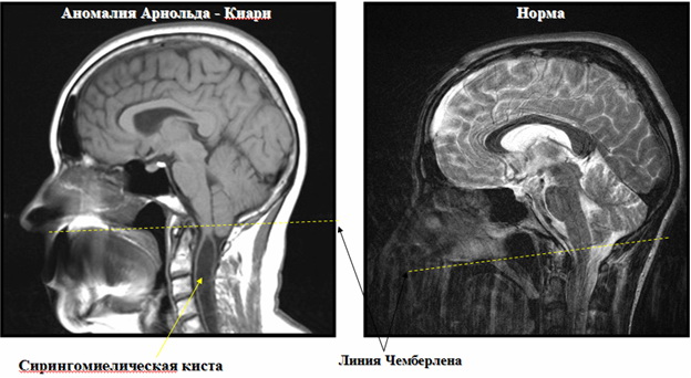 У плода синдром арнольда киари