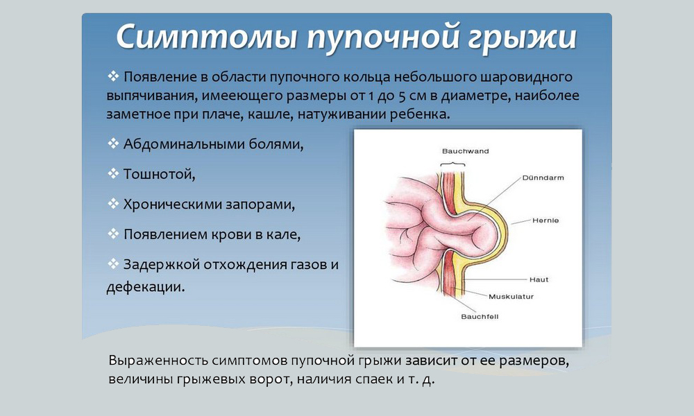 Грыжа околопупочная код мкб