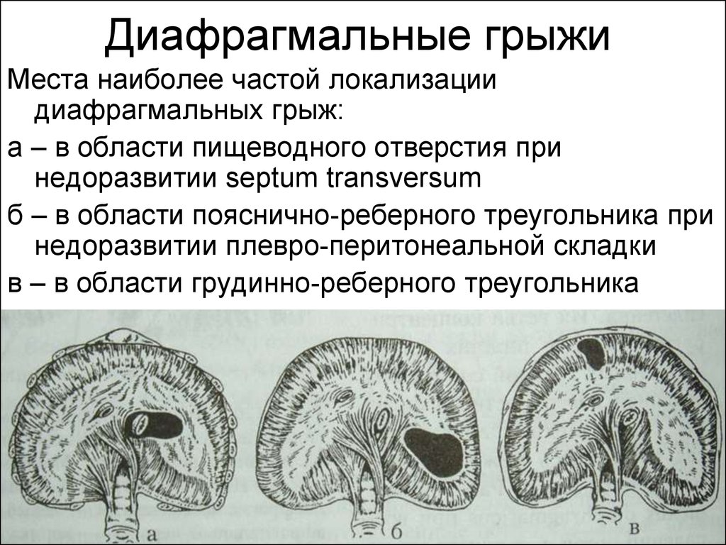 Грыжа околопупочная код мкб
