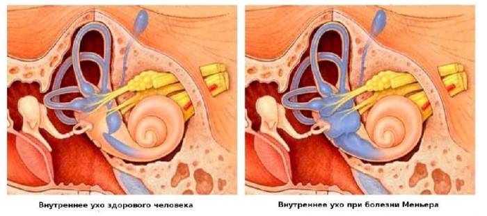 Что такое синдром меньера и как его лечить
